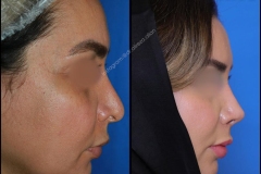 nose-surgery-0335
