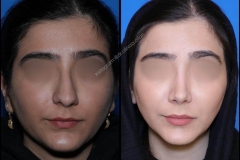 nose-surgery-0336