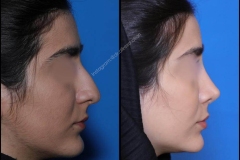 nose-surgery-0337