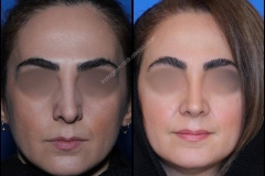 nose-surgery-0338