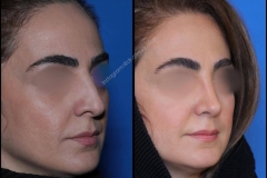 nose-surgery-0339