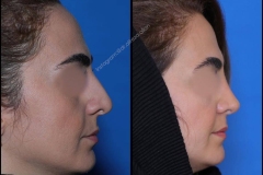 nose-surgery-0340