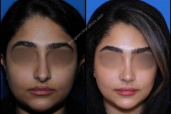 nose-surgery-0341
