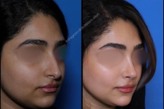 nose-surgery-0342