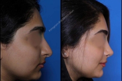 nose-surgery-0343
