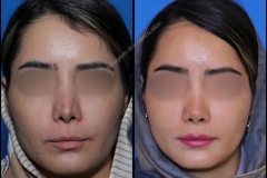 nose-surgery-0344