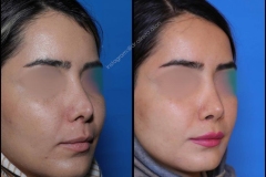 nose-surgery-0345