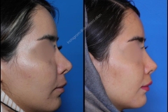 nose-surgery-0346