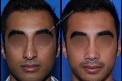 nose-surgery-0347