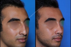 nose-surgery-0348