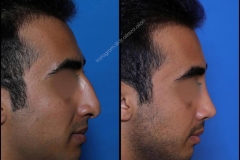 nose-surgery-0349