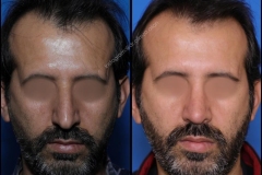 nose-surgery-0350