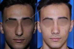 nose-surgery-0353