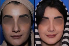 nose-surgery-0359