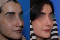 nose-surgery-0360