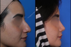 nose-surgery-0361