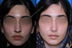 nose-surgery-0362