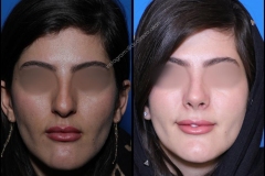 nose-surgery-0365