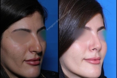 nose-surgery-0366