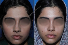 nose-surgery-0368