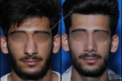 nose-surgery-0371