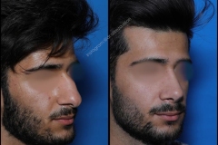 nose-surgery-0372