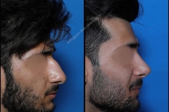 nose-surgery-0373
