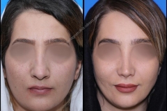 nose-surgery-0374