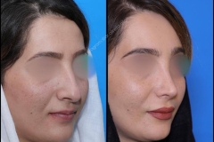 nose-surgery-0375