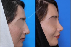 nose-surgery-0376