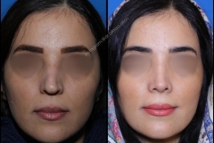 nose-surgery-0377