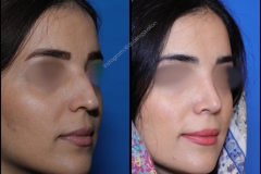 nose-surgery-0378