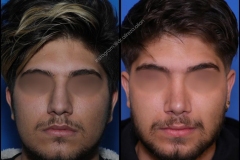 nose-surgery-0380