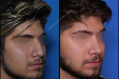 nose-surgery-0381