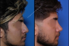 nose-surgery-0382