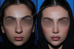 nose-surgery-0383