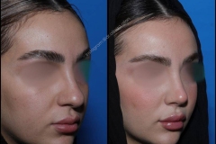 nose-surgery-0384