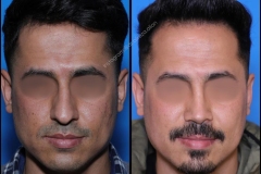 nose-surgery-0386