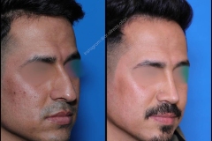 nose-surgery-0387