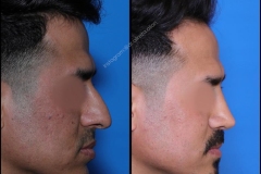 nose-surgery-0388