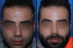 nose-surgery-0389