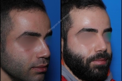 nose-surgery-0390