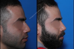nose-surgery-0391