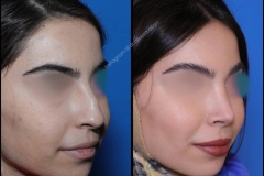 nose-surgery-0393