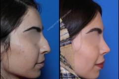 nose-surgery-0394