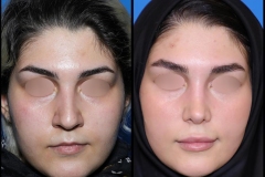 nose-surgery-0395