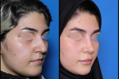 nose-surgery-0396