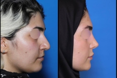 nose-surgery-0397