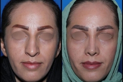 nose-surgery-0398