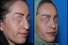 nose-surgery-0399